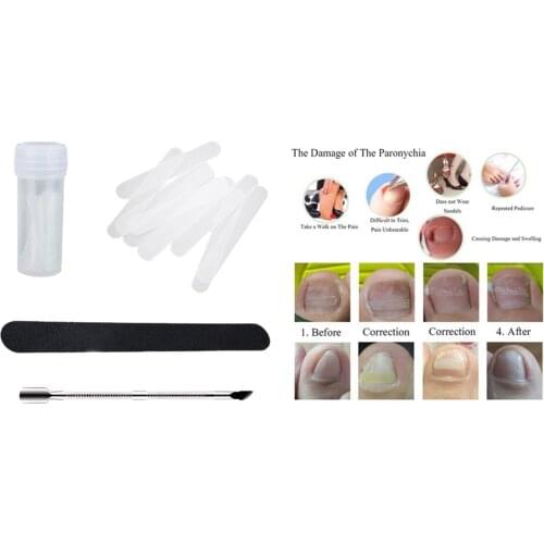 Ingrown Toenail Pedicure Tools, Straightening Clip Curved Brace, Toenails Thick Paronychia Correction Tool