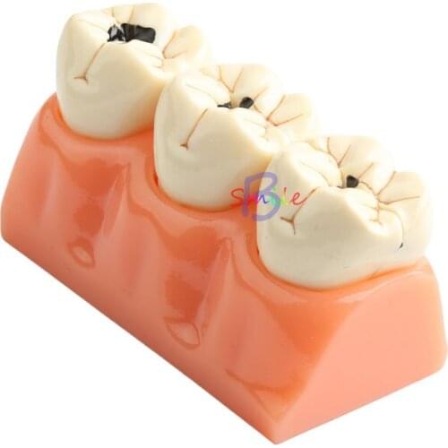 1pcs Dental Teaching Model Patient Dissected Caries Model Oral Dental Tooth Model Can be removed
