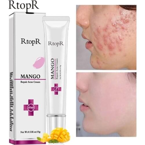 RtopR Acne Treatment Face Cream Anti-Acne Oil Control Shrink Pores Facial Whitening Cream Acne Treatment Moisturize Repair Skin