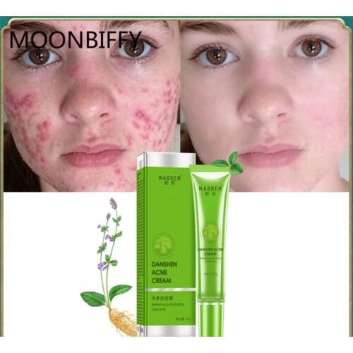 Acne Treatment Skin Care Remove Acne Oil Control Oil Shrink Pores Whitening and Moisturizing Scar Removal Facial cream