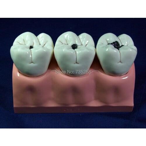 Four Times Magnification Caries Model,Caries Pathology Model,Dental Model