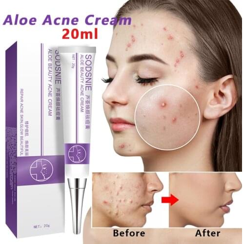 Anti-Acne-Cream Oil-Control Face Skin Care Repair Comedone Pimple Natural Herbal Remove Scar Gel Treatment Remover Facial 20g