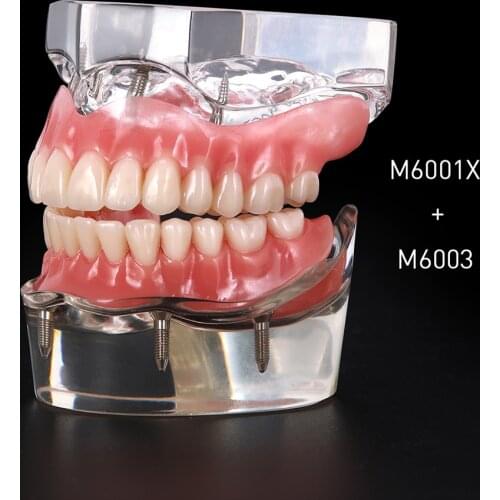 Dental Implant Restoration Teeth Model Removable Bridge Denture Demo Disease Teeth Model With Restoration Bridge Teaching Study