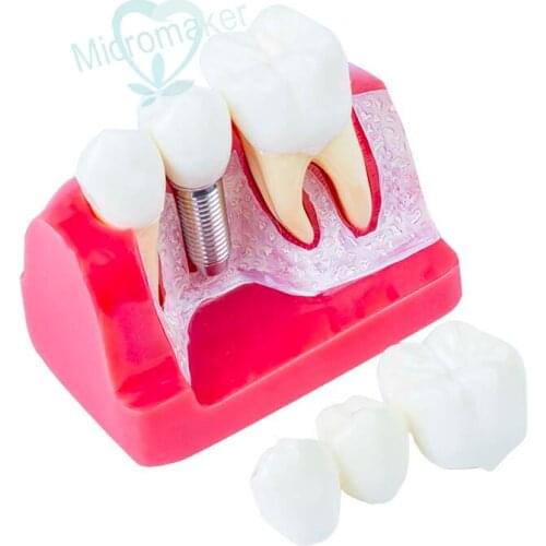 1pc Dental Demonstration Teeth Model Implant Analysis Crown Bridge Teeth Model New