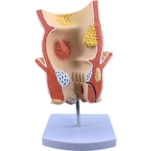 Hemorrhoids rectal pathological model Ulcerative colon disease bowel anatomical pathological model