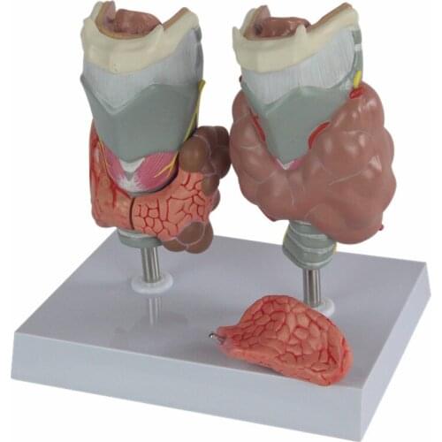 Thyroid pathology model Thyroid model Throat model Thyroid disease model