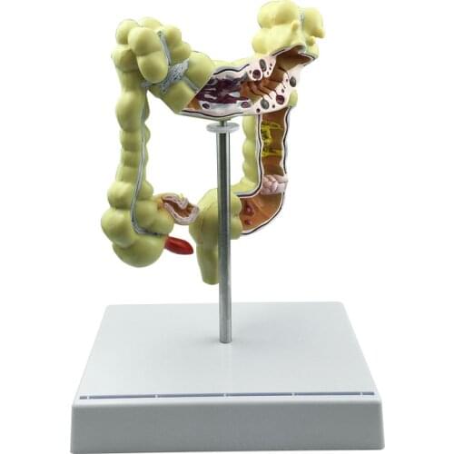 Human Colon Disease Model Human Anatomy of Large Intestine Model In Gastroenterology Department of Anorectal Department
