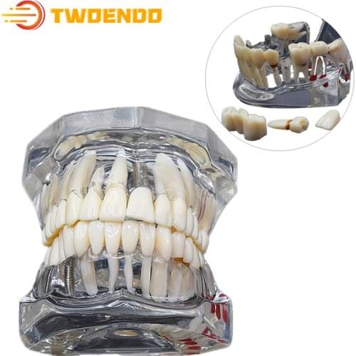 Dental Lab Consumable Teeth Model Medical Studying Implant Disease With Restoration Bridge Tooth Dental Teaching Model