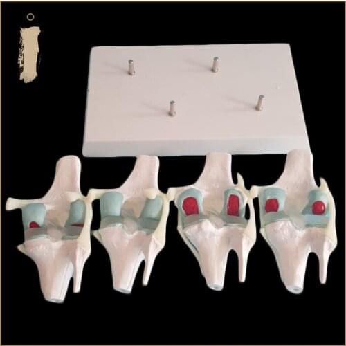 Pathological knee joint model knee joint degenerative knee arthroscopy arthroscopic surgery education model