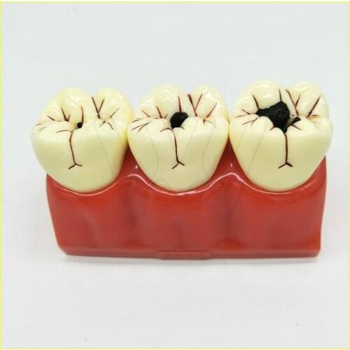4 times Denture Disease Teeth Model Caries Decomposition Decay Tooth Model For Dental Medical Demo Communication Teaching