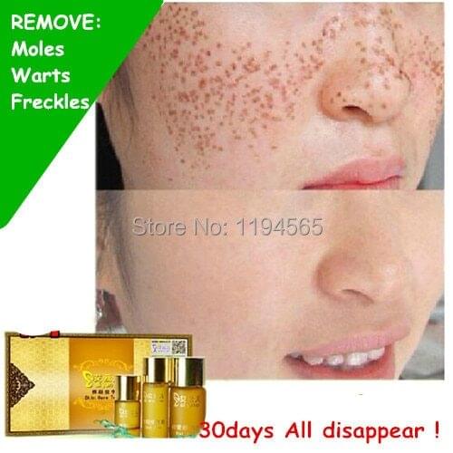 Sploshes Drops Facial Cream Speckles Freckles remove Seamless Water Warts Remove Moles Removal Free Shipping