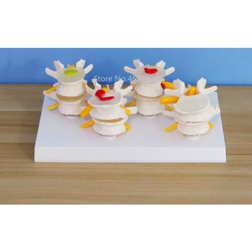 High Quality 4 Part Anatomical Human Lumbar Vertebrae Degenerative Disc Disease Medical Model