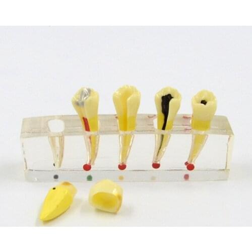 Human Teeth Dental Pulp Pathology Treatment Repair Model