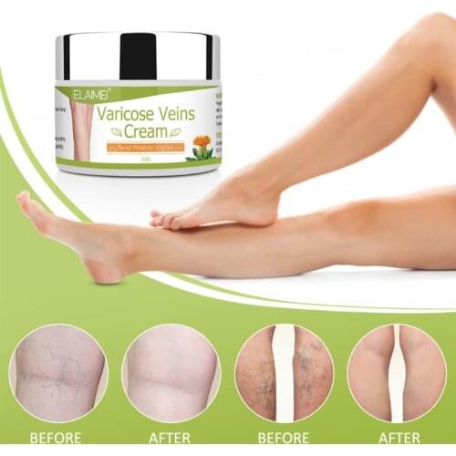 50g Varicose Veins Cream Phlebitis Angiitis Treatment Pain Relief Effective Improve Inflammation Rotten Legs Ointment D0UE