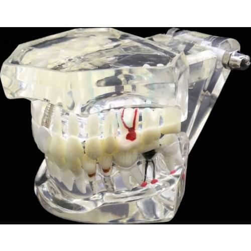 Dental Restoration Tooth Model Implant Disease Teeth Model with Bridge Detachable Teeth Disease Teaching Study Model