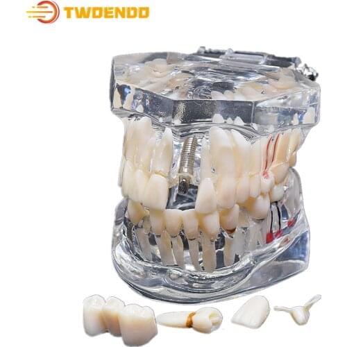 Dental Consumable Teeth Model Medical Studying Implant Disease With Restoration Bridge Tooth Dental Teaching Model