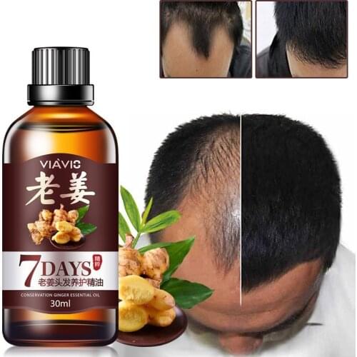 30ml Magic Fast Hair Growth Dense Regrowth Ginger Oil Anti Loss Treatment Essence Bin Wild Hair Growth Tools Hair Care