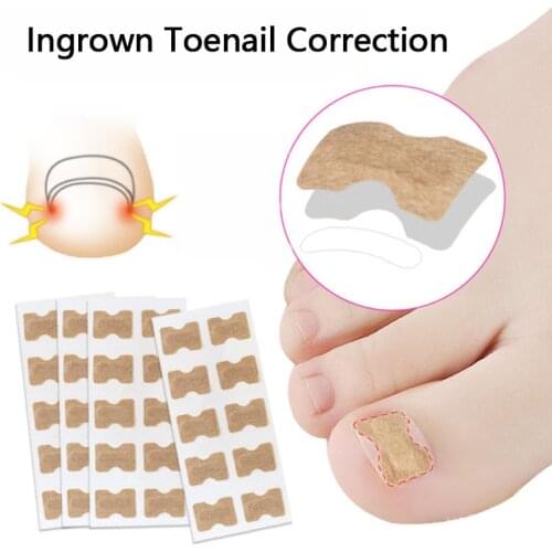 20/50pcs Ingrown Toenail Correction Stickers Paronychia Treatment Recover Toe Nail Repair No Glue Feet Patch Corrector Pedicure