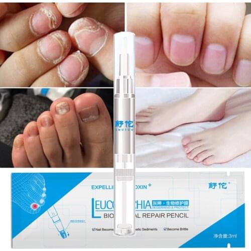 1/ 3Pc 3ML Nail Fungal Treatment Feet Care Essence Nail Foot Toenail Fungus Removal Gel Anti Infection Paronychia Onychomycosis