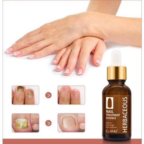 30ml Nail Anti Fungal Feet Care Nail Foot Whitening Toe Nail Fungus Removal Gel Anti Paronychia Onychomycosis Nail Tool