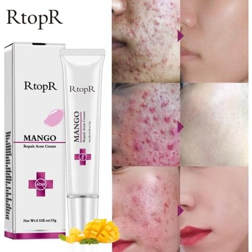 Acne Treatment Face Cream Blackhead Repair Gel Oil Control Shrink Pores Scar Whitening Moisturizer Skin Care Korean Cosmetics