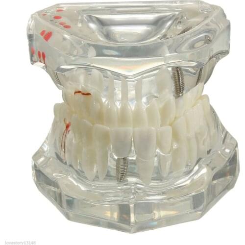 New Dental Implant Disease Teeth Model With Restoration Bridge Tooth Dentist For Medical Science Dental Disease Teaching Study