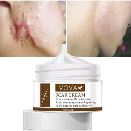 VOVA Acne Scar Cream 30ml Whitening Skin Repair New Old Scar Brightening Pimples Scars Stretch Marks Remover Cream 100% Natural