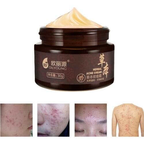 Natural Herbal Anti-acne Cream Anti Pimple Spot Acne Scars Blackhead Removal Cream Whitening Beauty Skin Face Care Creams