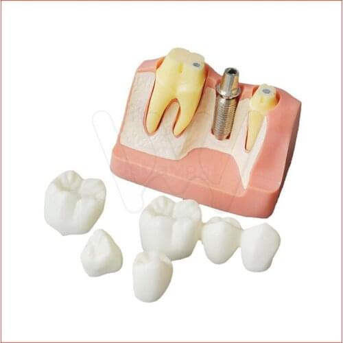 Dental Demonstration Teeth Model Implant Analysis Crown Bridge