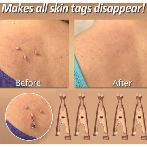 5PCS Portable Mini Metal Alligator Clip Copper Tag Remover Face Acne Pimple Remover Alligator Clip Safety Clip Set