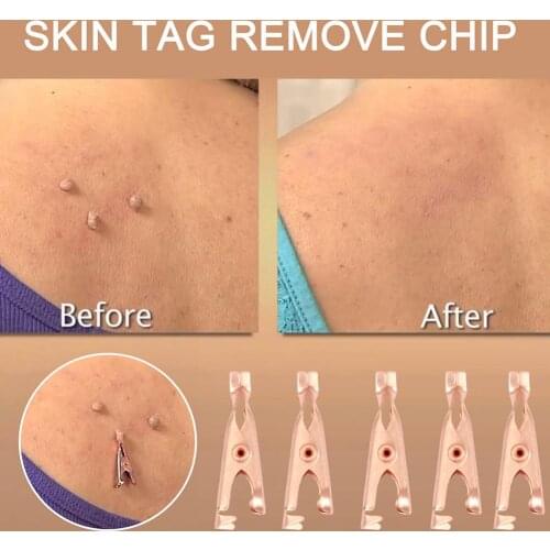 Skin Tags Remover Copper Small Wart Tattoo Clip Extractor Tools Out Remover Skin Wart Tags Tattoo Clippers Beauty Removal Tools