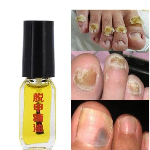 3 Dagen Effect Echt Werken Nail Behandeling Van Paronychia Anti Olie Schimmel Nagel Infectie Teen Nagel Schimmel Olie