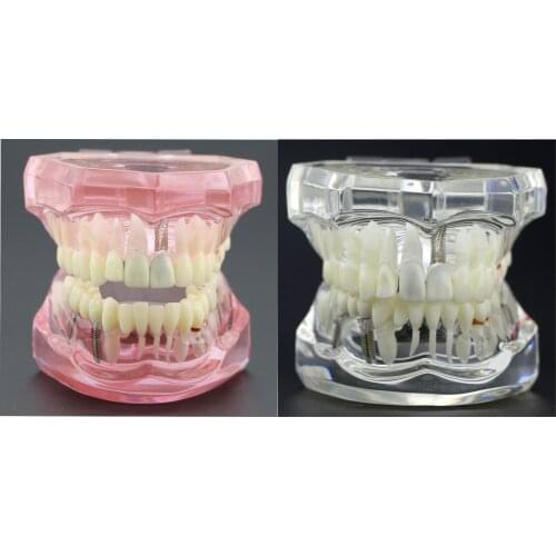 Dental Implant Restoration Disease Analysis Demo Study Teeth Model Typodont 2001