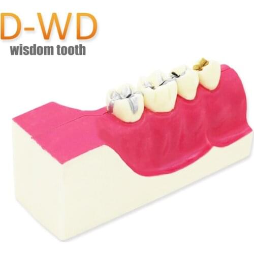 D-WD Teeth Model Dentist student Model for Teaching Dentist Tools Dental Lab Model Caries 6 times tooth