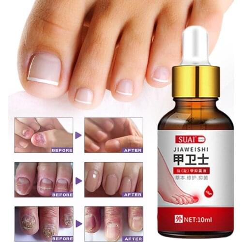 Nail Fungus Treatment Feet Care Essence Nail Foot Whitening Toe Nail Fungus Removal Gel Anti Infection Paronychia Onychomycosis