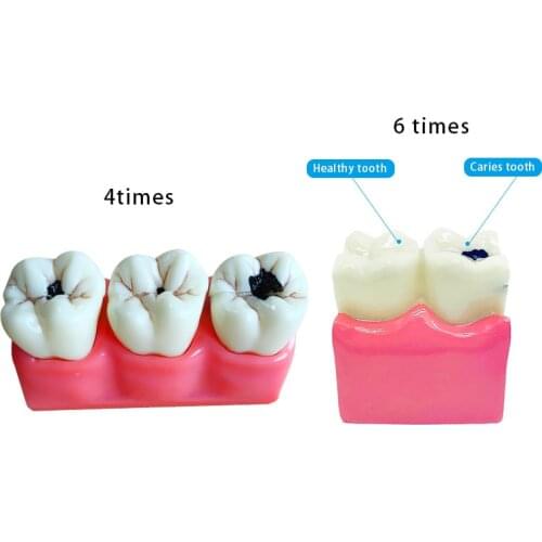 Dental Teeth Model Caries Model Teeth Dentist Dental Disease Teaching Model
