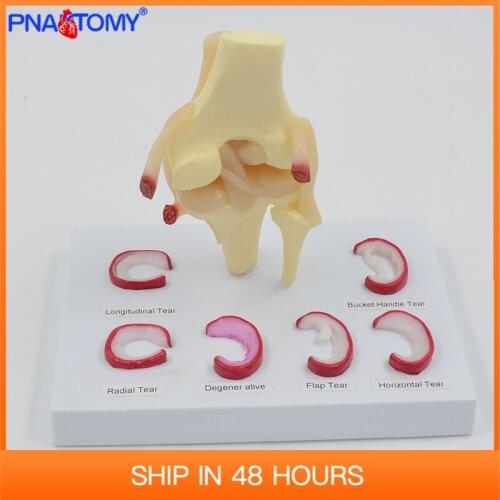 Life Size Knee joint model with ligaments shows meniscus tears Medical Teaching Tool Anatomical Model Skeleton Anatomy