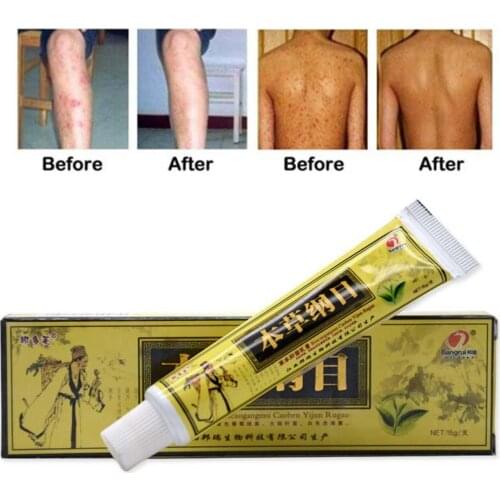 1 Pcs Eczema Psoriasis Antibacterial Ointment Treatment Cream Herbal Care Medicine Chinese Skin Natural Pruritus Problems M8F0