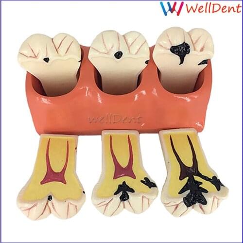 Dental Teeth Model 4 Times Denture Disease Caries Decomposition Decay Tooth Model For Dental Demo Communication Teaching