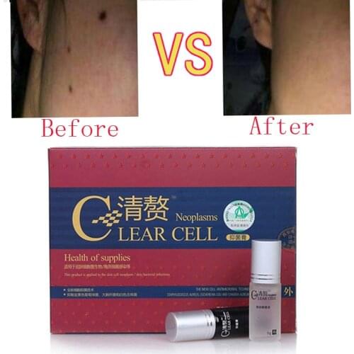 Chinese Medication Speckle Freckle Moles Remove Water Speckle Freckle Seamless Water Drops Skin Tags Removal Cream