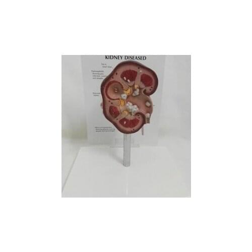 Renal anatomy teaching aids Model of medical instrument Renal pathological Health dissection model free shipping
