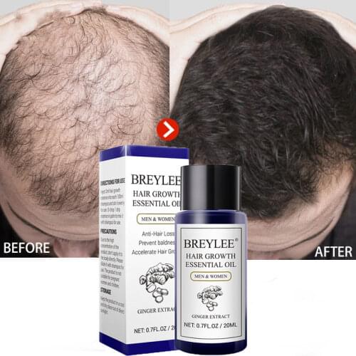 DEleventh Hair Loss Remedies