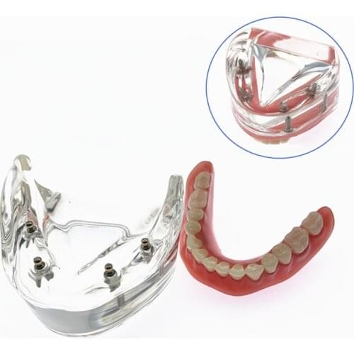 Dental Model With Implant Overdenture Inferior Demo Teeth model Study Model