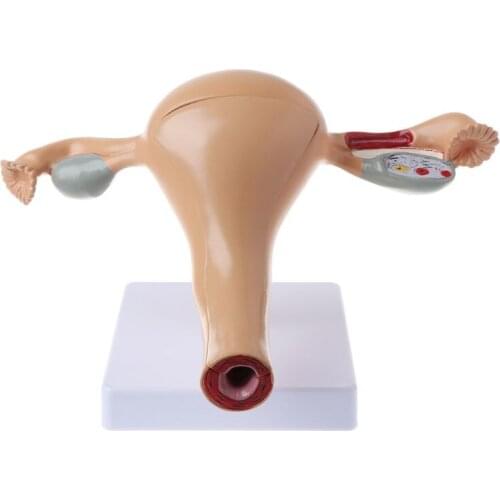 Human Pathological Uterus Ovary Model Anatomical Anatomy Disease Pathology Medical Lesion For Teaching