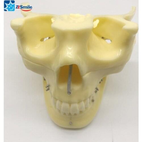 M2016 Implant Practice Model For Showing the Exact Position for Ortho Implant