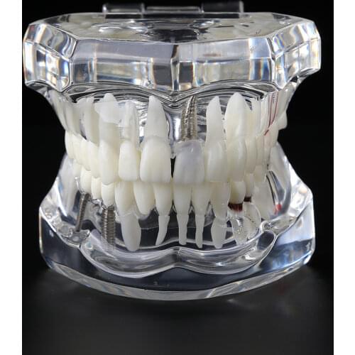 Resin Dental Orthodontic Model Oral Teeth Model for Oral Health Teaching Dental Teeth Study Model Health Care