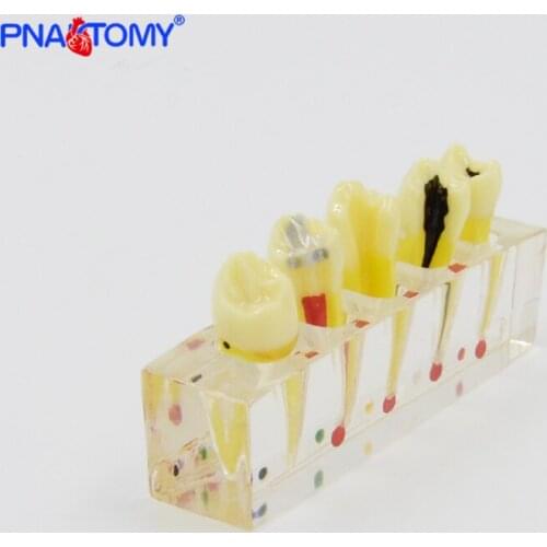 Endodontic pathological model pathology Patient communication model Endodontic treatment Posterior Teeth Dental Pulp Restoration