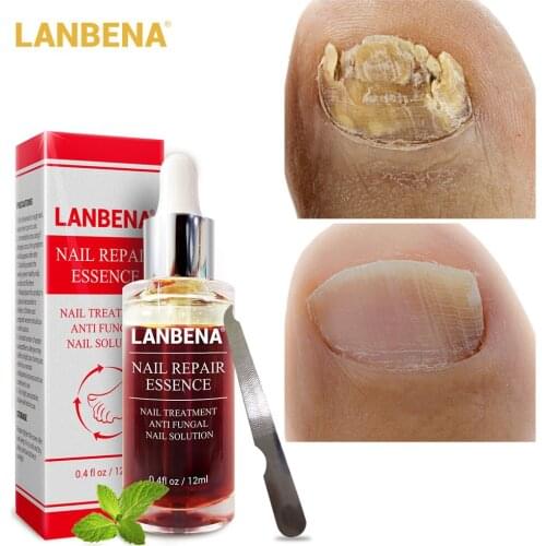 LANBENA Nail Repair Essence Fungal Serum Treatment Improve Damage Nails Paronychia Anti Infection Onychomycosis Gel Foot Care
