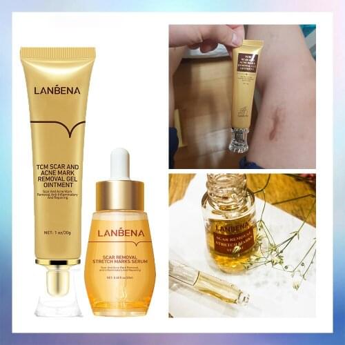 2PCS 50ml/set LANBENA Acne Scar Remove Serum Acne Treatment Cream Skin Repair Stretch Marks Anti Acne Shrink Pores Blackhead