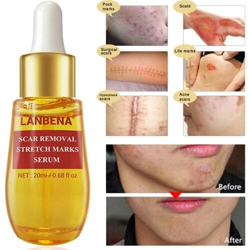 Herbal Formula Scar Serum For Face Body Hyperplastic Scars Stretch Marks Removing Treatment Scar Serum Compound Essential Oil